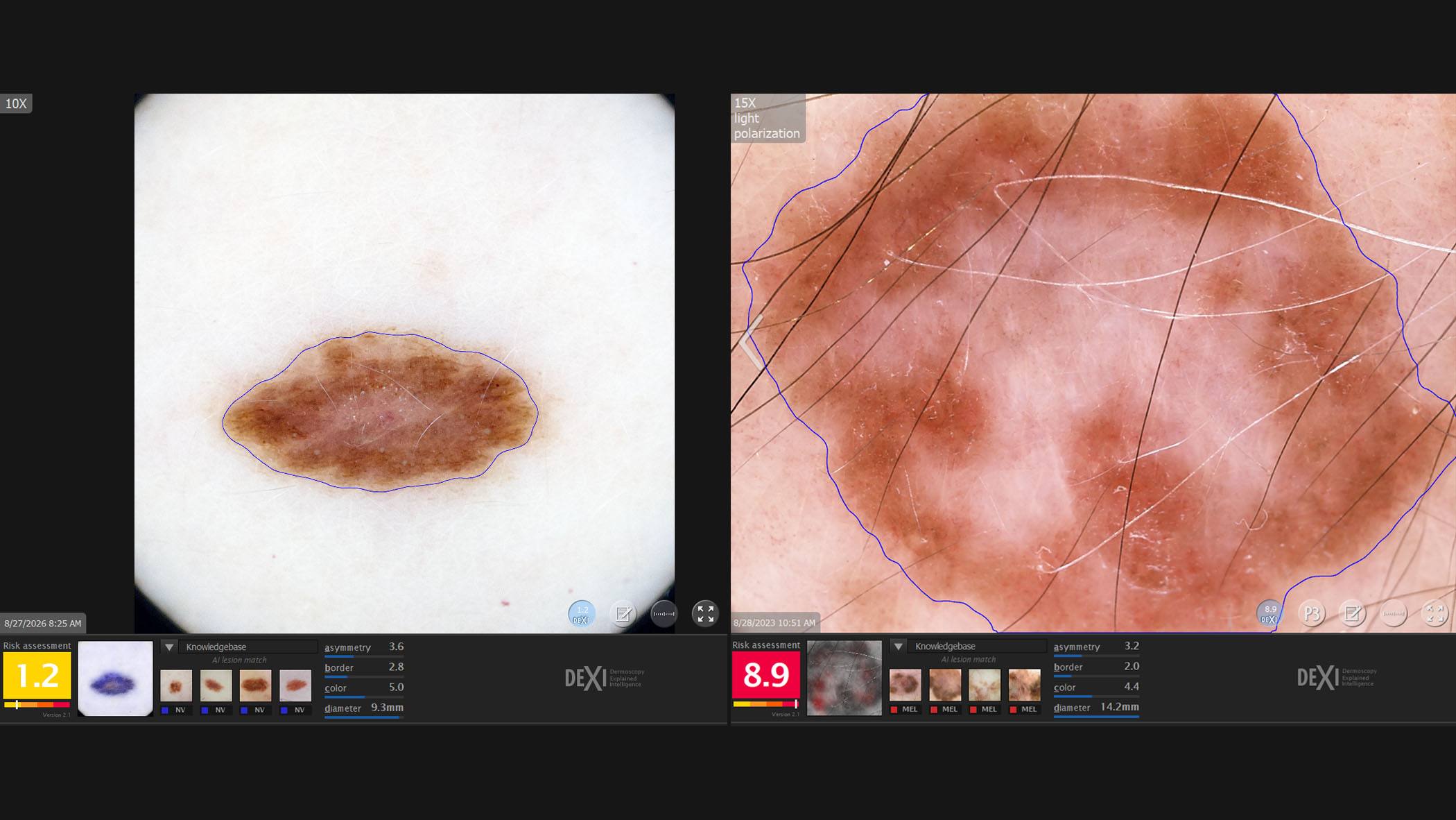 AI tool may support dermatologists in assessing skin lesions for cancer risk featured image