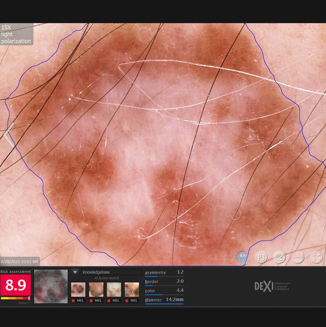 AI tool may support dermatologists in assessing skin lesions for cancer risk featured image